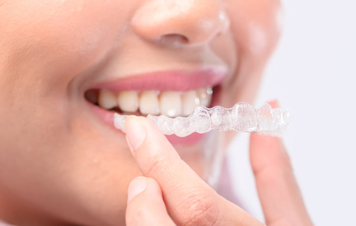invisalign-braces